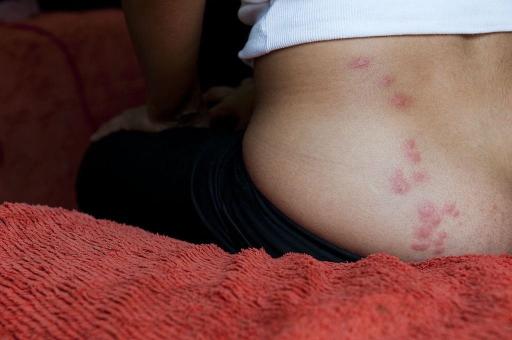 bed-bug-bite bed bug bite
